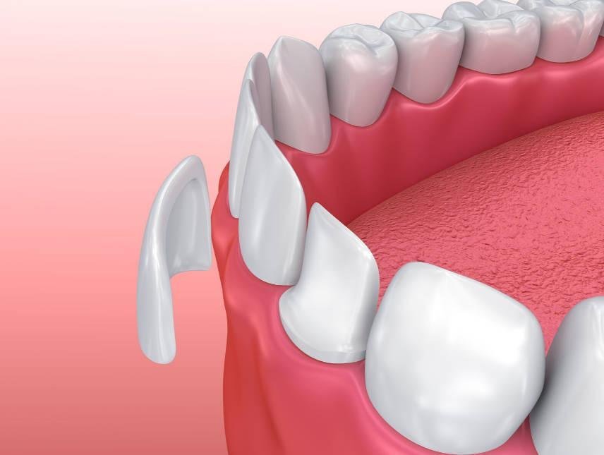 Carilles Dentals