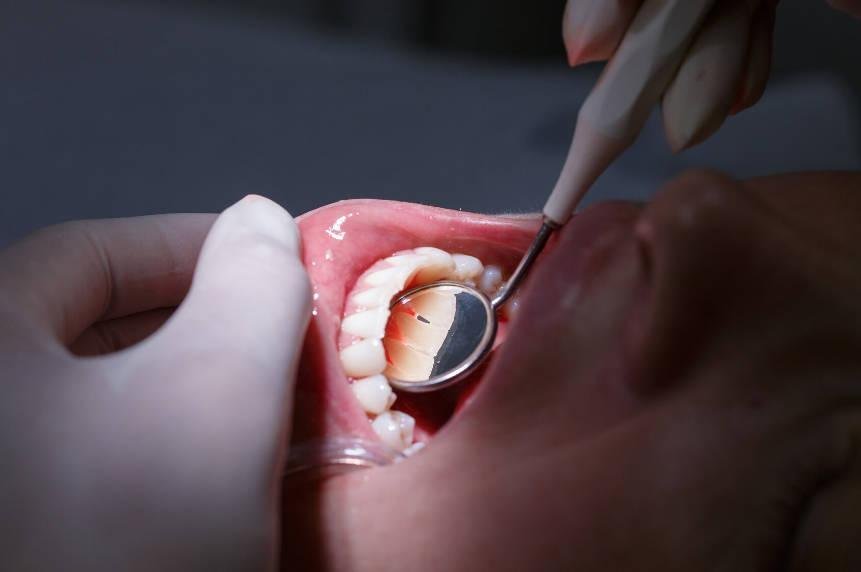 Gingivitis